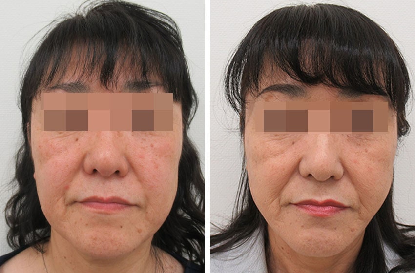 TAC式 ツヤ肌コラーゲンリフト®の症例写真 施術前後 １ヵ月