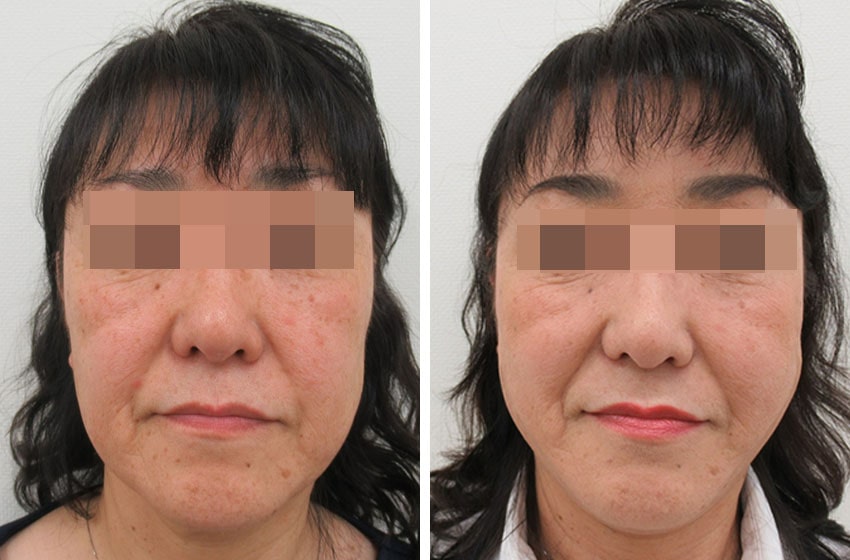 TAC式 ツヤ肌コラーゲンリフト®の症例写真 施術前後 １週間
