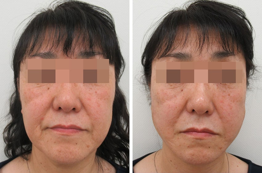 TAC式 ツヤ肌コラーゲンリフト®の症例写真 施術前後 直後