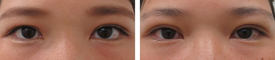 くっきりとした二重瞼になりました