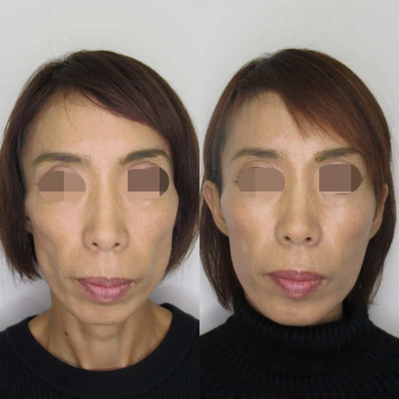 コケて弛んだ頬をどう改善するか 二か月経過です Taクリニック公式整形ブログ 画像 値段 美容整形 美容外科