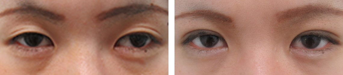 くっきり二重で優しい目元に変化