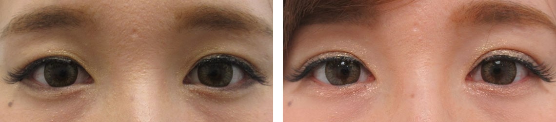 切らずに自然な二重幅に