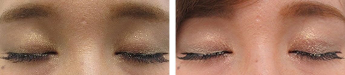 二重埋没法の症例写真 施術前後 1ヵ月