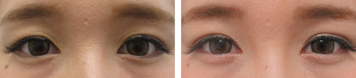 二重埋没法の症例写真 施術前後 2週間