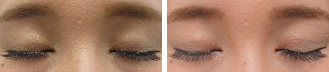 二重埋没法の症例写真 施術前後 2週間