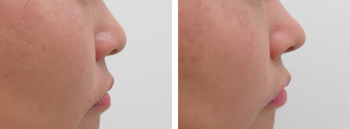 鼻尖形成・鼻尖縮小/鼻尖4Dノーズの症例写真 施術前後 １ヵ月