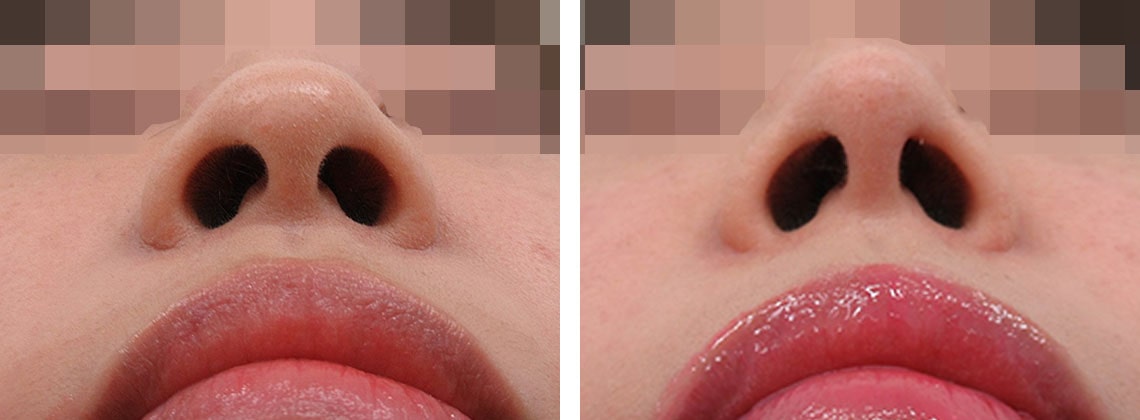 鼻尖縮小術と鼻尖４Dノーズの組み合わせ