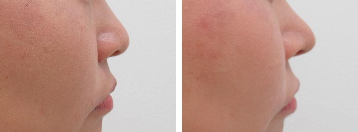鼻尖形成・鼻尖縮小/鼻尖4Dノーズの症例写真 施術前後 １週間