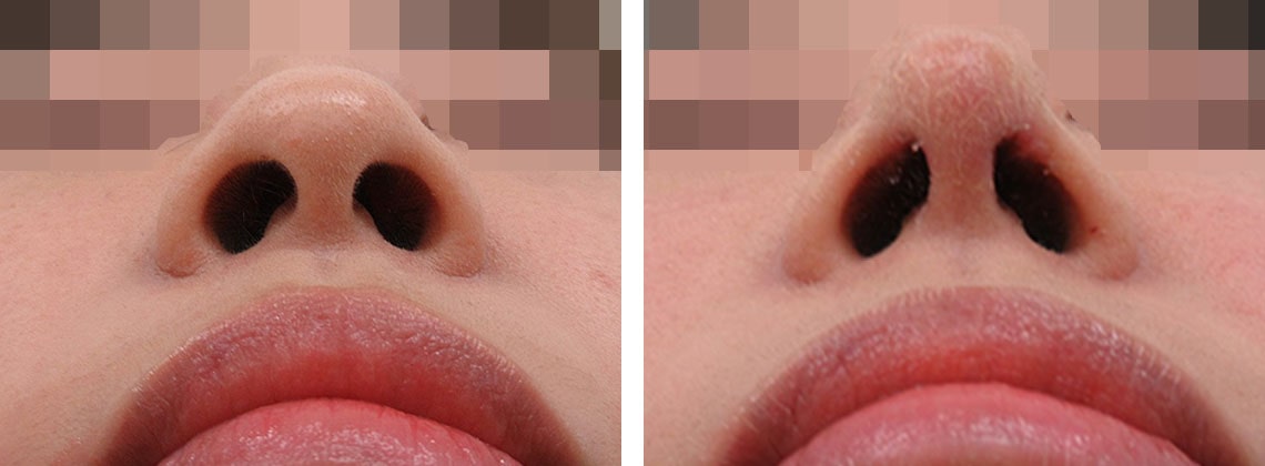 鼻尖形成・鼻尖縮小/鼻尖4Dノーズの症例写真 施術前後 １週間