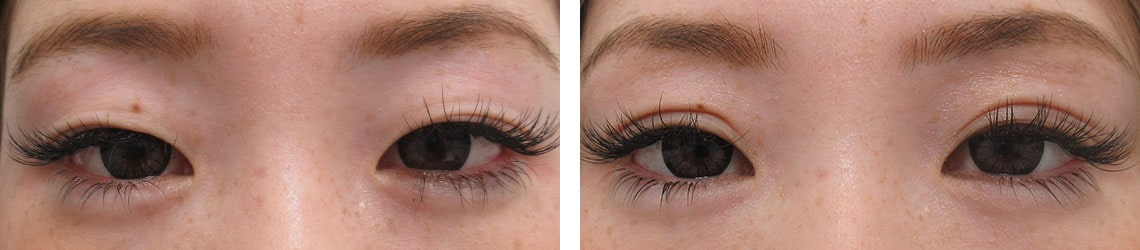 二重埋没法の症例写真 施術前後 1ヵ月