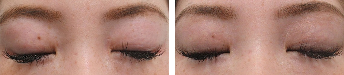 二重埋没法の症例写真 施術前後 1ヵ月