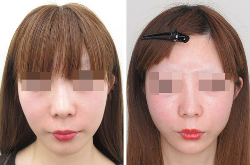 TAC式 ツヤ肌コラーゲンリフト®の症例写真 施術前後 1ヵ月