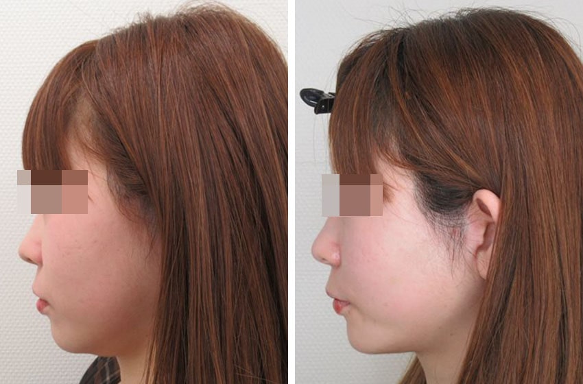 TAC式 ツヤ肌コラーゲンリフト®の症例写真 施術前後 1ヵ月