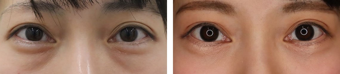 下眼瞼切開術で目元のたるみを改善