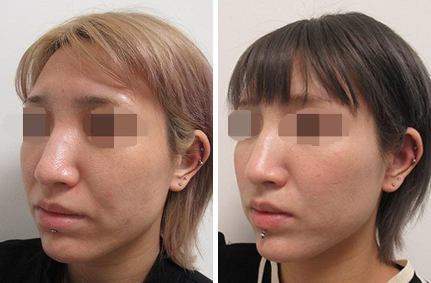 TAC式 ツヤ肌コラーゲンリフト®/エラボトックス注射/ほうれい線のヒアルロン酸注射の症例写真 施術前後 １ヵ月