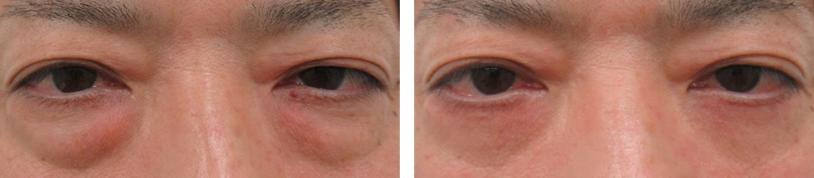 下眼瞼切開術（クマ・たるみとり）の症例写真 施術前後 ４ヵ月