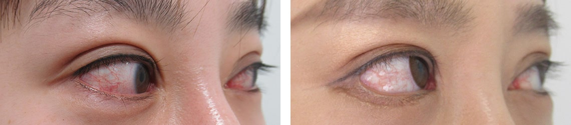 グラマラスライン（タレ目形成）/目尻靭帯移動術の症例写真 施術前後 １ヵ月半