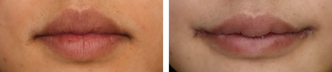 口唇縮小術/口角挙上・リフト（マイクロ切開法・内側法/口内法）/ラシャスリップス（医療機関専売）の症例写真 施術前後 １週間