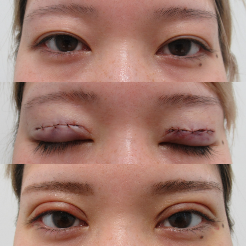 匠の施術 予定外重瞼線に対しての対策 Taクリニック公式整形ブログ 画像 値段 美容整形 美容外科