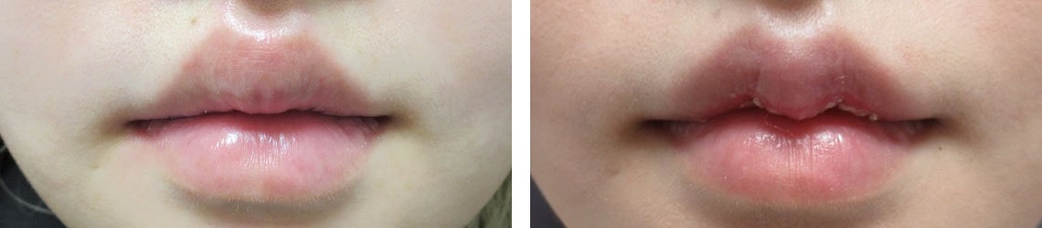 M字リップ形成術/ラシャスリップス(医療機関専売)の症例写真 施術前後 1ヵ月