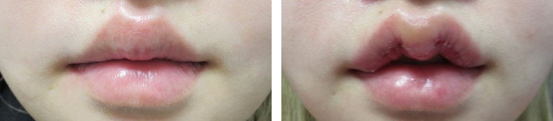 M字リップ形成術/ラシャスリップス(医療機関専売)の症例写真 施術前後 1週間