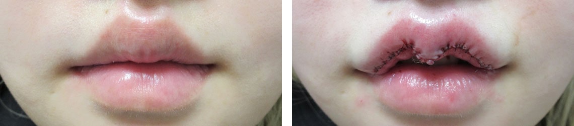 M字リップ形成術/ラシャスリップス(医療機関専売)の症例写真 施術前後 直後