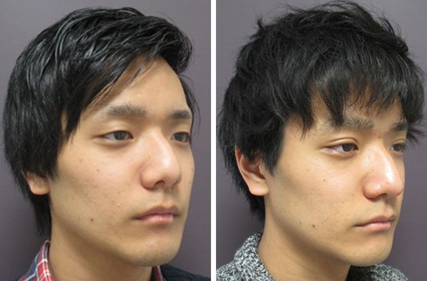 鼻筋・小鼻の症例写真一覧｜【公式】TAクリニック｜美容整形･美容外科･美容皮膚科｜銀座･新宿･福岡･大阪･高崎