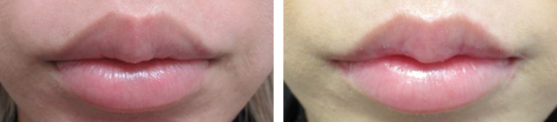 M字リップ形成術/口角挙上・リフト（マイクロ切開法・内側法/口内法）の症例写真 施術前後 １ヵ月