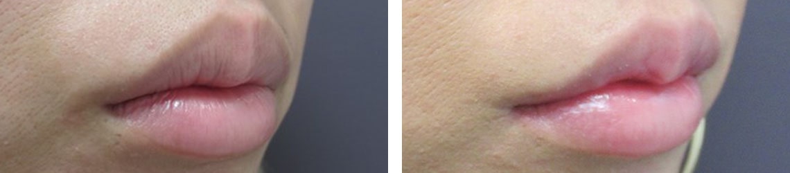 M字リップ形成術/口角挙上・リフト（マイクロ切開法・内側法/口内法）の症例写真 施術前後 １ヵ月