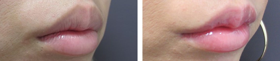 M字リップ形成術/口角挙上・リフト（マイクロ切開法・内側法/口内法）の症例写真 施術前後 １ヵ月（ラシャス付）