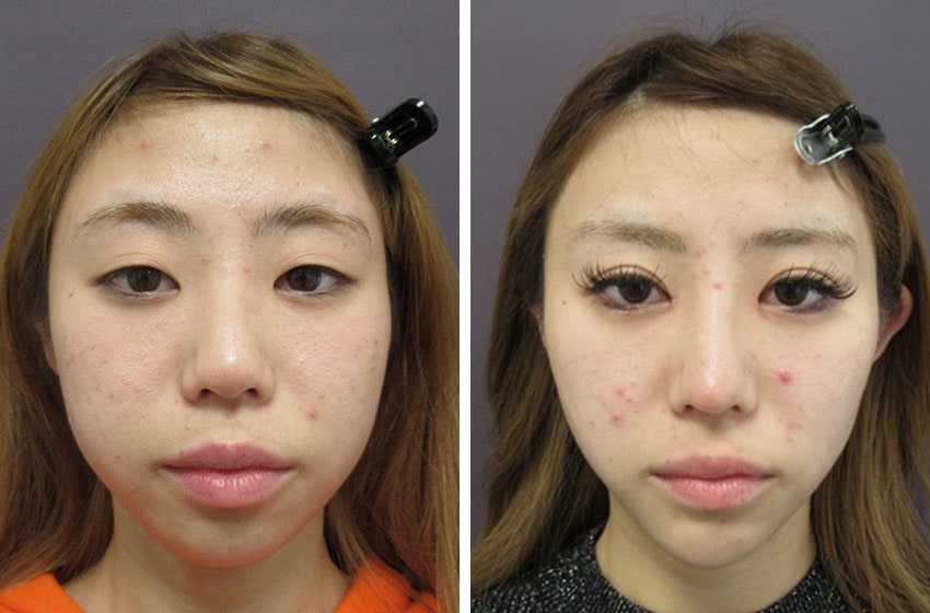 TAC式 ツヤ肌コラーゲンリフト®/バッカルファット除去/二重埋没法の症例写真 施術前後 １ヵ月