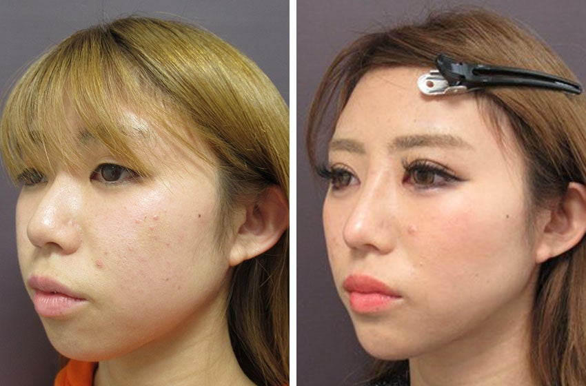 TAC式 ツヤ肌コラーゲンリフト®/バッカルファット除去/二重埋没法の症例写真 施術前後 １ヵ月（メイク有）