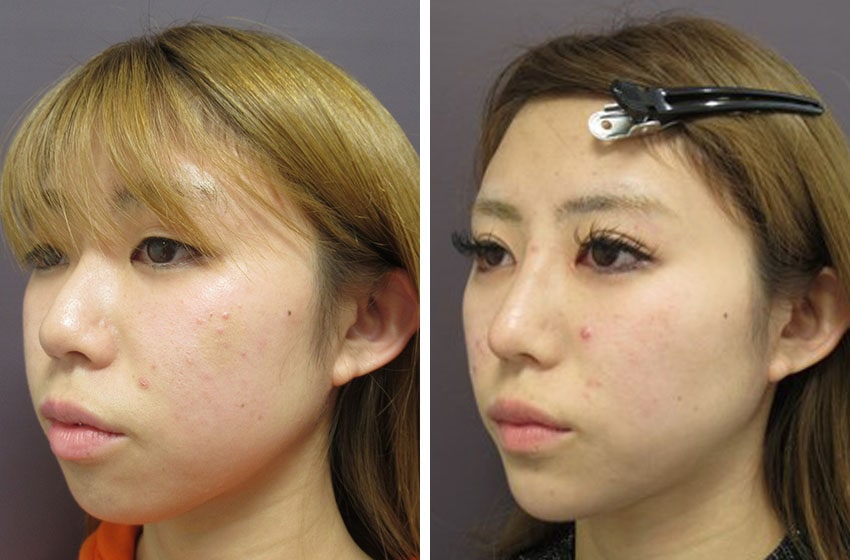 TAC式 ツヤ肌コラーゲンリフト®/バッカルファット除去/二重埋没法の症例写真 施術前後 １ヵ月