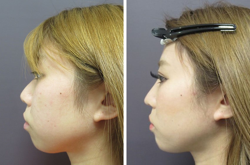 TAC式 ツヤ肌コラーゲンリフト®/バッカルファット除去/二重埋没法の症例写真 施術前後 １ヵ月（メイク有）