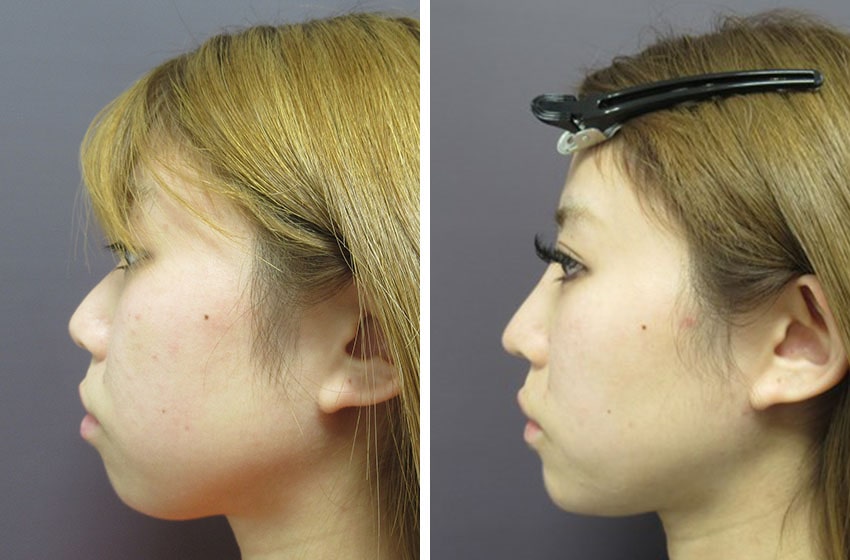 TAC式 ツヤ肌コラーゲンリフト®/バッカルファット除去/二重埋没法の症例写真 施術前後 １ヵ月