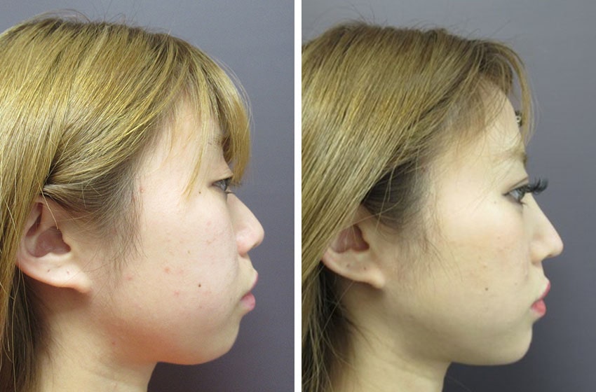 TAC式 ツヤ肌コラーゲンリフト®/バッカルファット除去/二重埋没法の症例写真 施術前後 １ヵ月（メイク有）