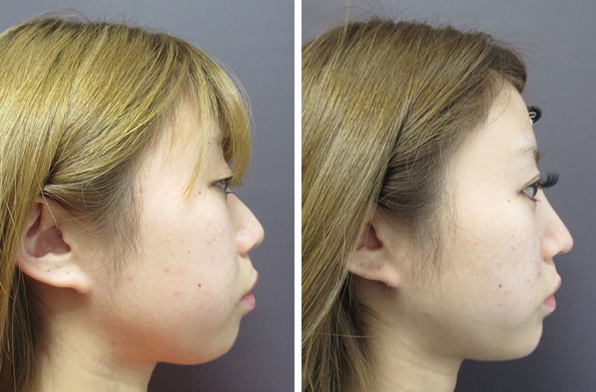 TAC式 ツヤ肌コラーゲンリフト®/バッカルファット除去/二重埋没法の症例写真 施術前後 １ヵ月