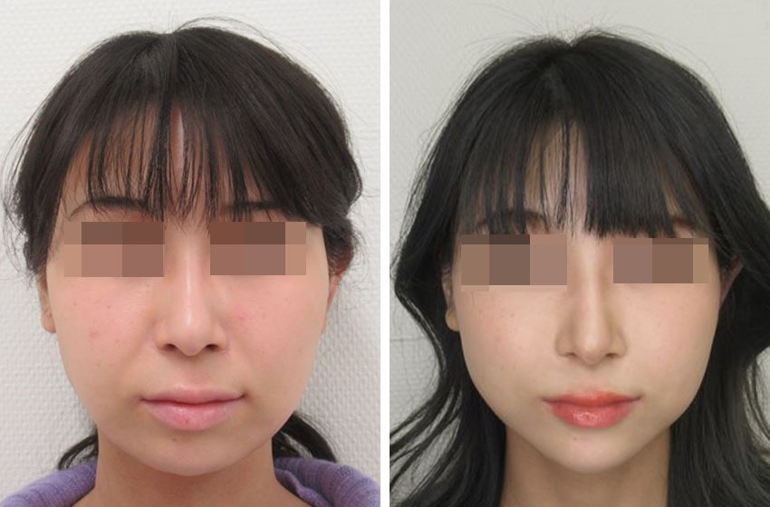 メーラーファットを除去してスッキリとした顔に