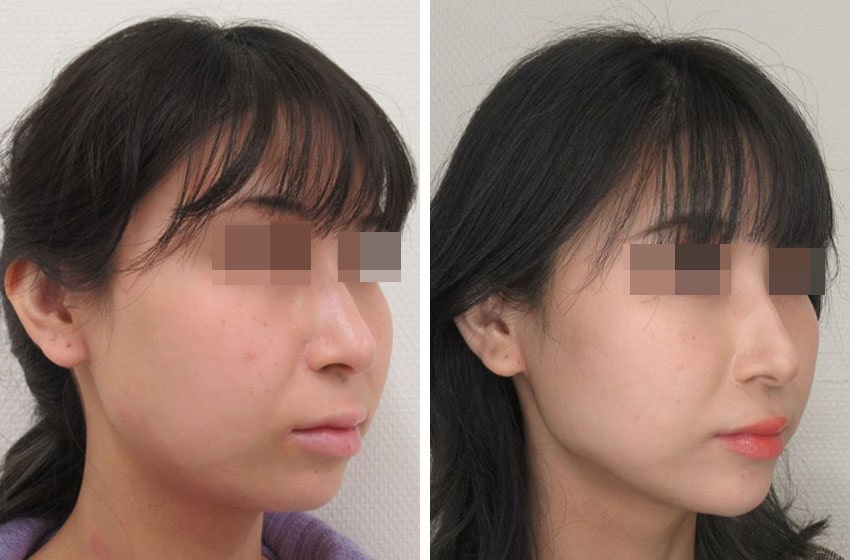 メーラーファット除去/バッカルファット除去/TAC式 ツヤ肌コラーゲンリフト®の症例写真 施術前後 １ヵ月