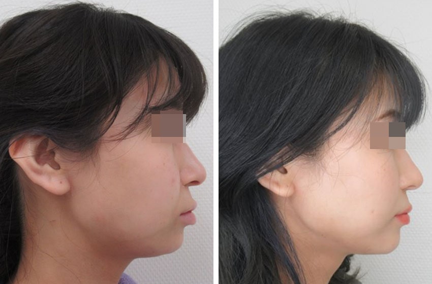 メーラーファット除去/バッカルファット除去/TAC式 ツヤ肌コラーゲンリフト®の症例写真 施術前後 １ヵ月