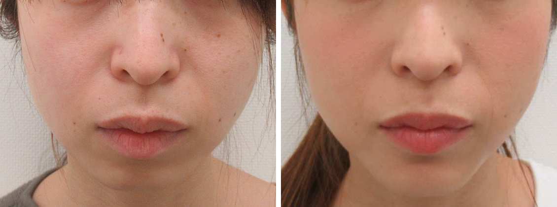 下顎プロテーゼの症例写真 施術前後 2か月後