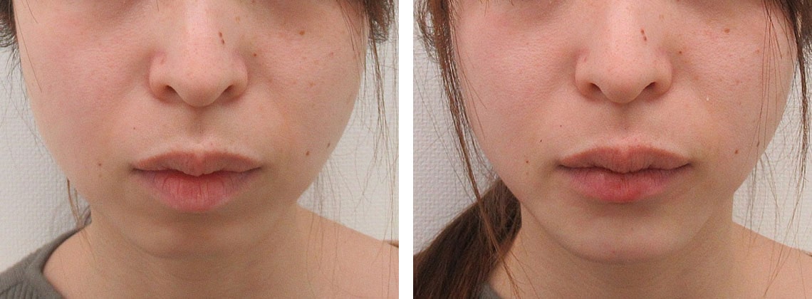 下顎プロテーゼの症例写真 施術前後 直後