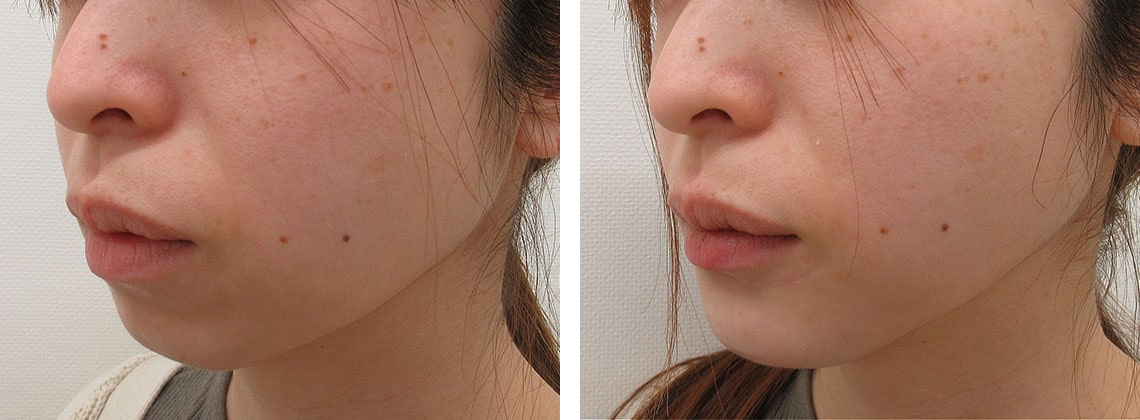 下顎プロテーゼの症例写真 施術前後 直後