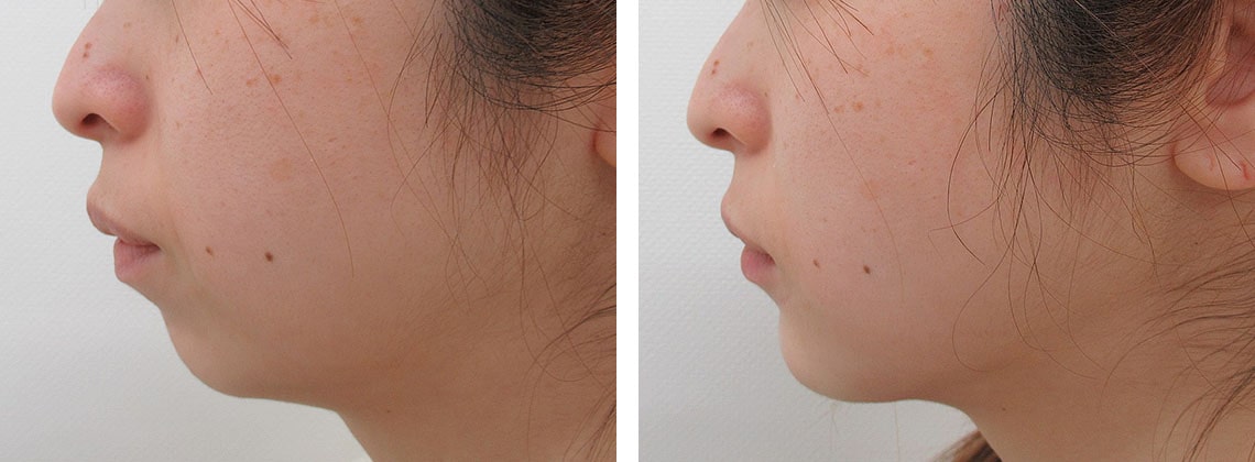 下顎プロテーゼの症例写真 施術前後 直後