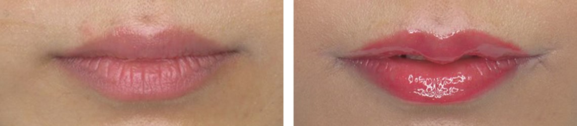 M字リップ形成術/口角挙上・リフト（マイクロ切開法・内側法/口内法）の症例写真 施術前後 １ヵ月