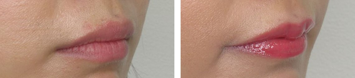 M字リップ形成術/口角挙上・リフト（マイクロ切開法・内側法/口内法）の症例写真 施術前後 １ヵ月