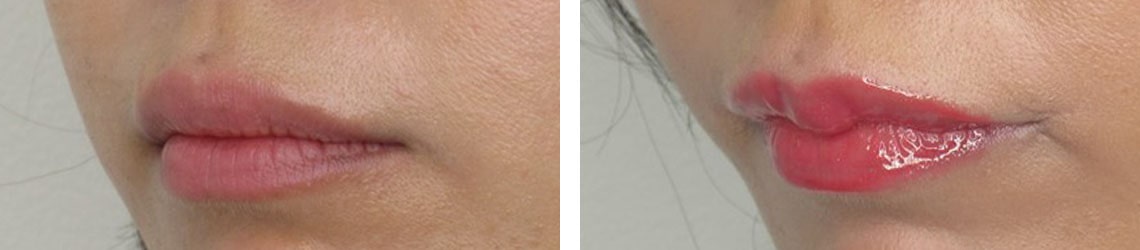 口元を可愛くするならM字リップ形成術がおすすめです