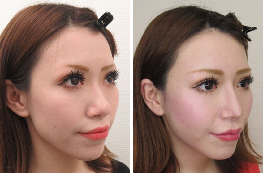 TAC式 ツヤ肌コラーゲンリフト®/バッカルファット除去/グラマラスライン(タレ目形成)の症例写真 施術前後 1ヵ月(ラシャスNo.329)