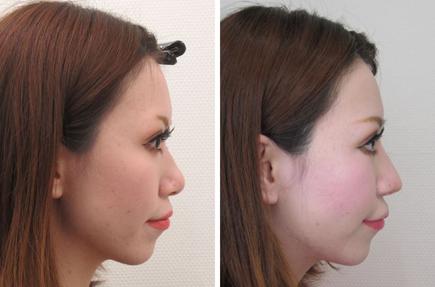 TAC式 ツヤ肌コラーゲンリフト®/バッカルファット除去/グラマラスライン(タレ目形成)の症例写真 施術前後 1ヵ月(ラシャスNo.329)